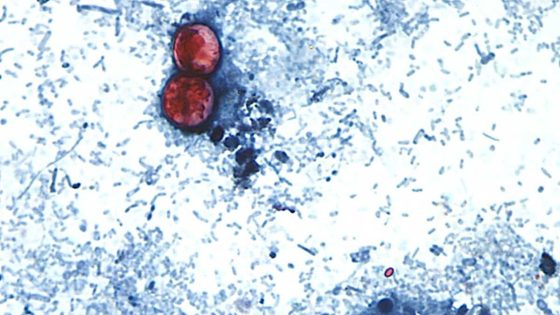 Two Cases of Cyclosporiasis Confirmed in New Hampshire, Health Officials Report
